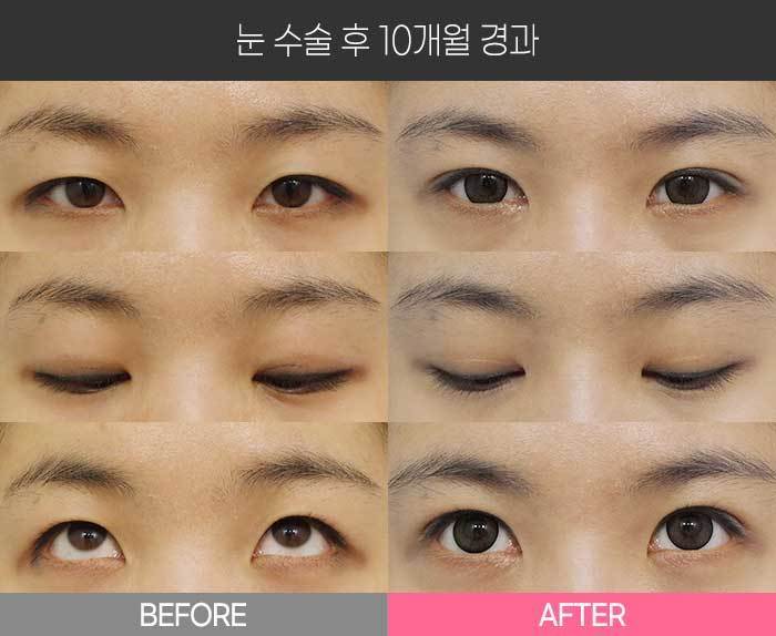 눈 수술 후 10개월 경과