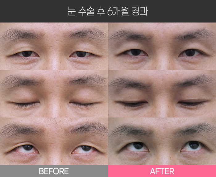 눈 수술 후 6개월 경과