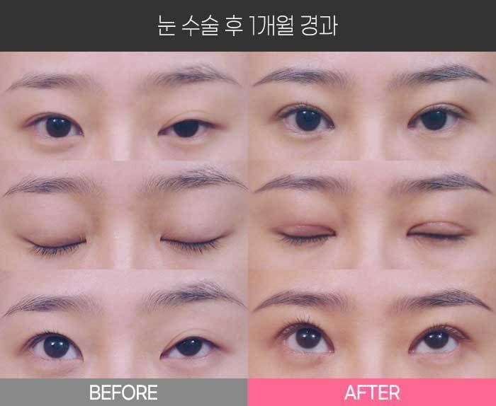 눈 수술 후 1개월 경과