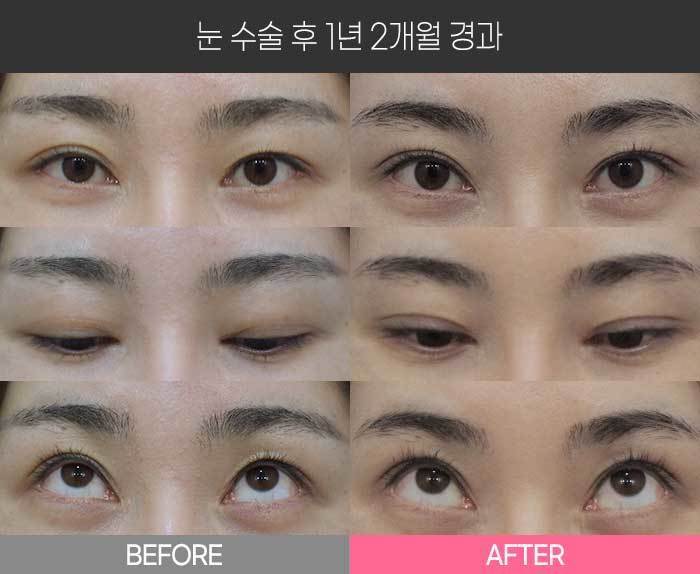 눈 수술 후 1년 2개월 경과