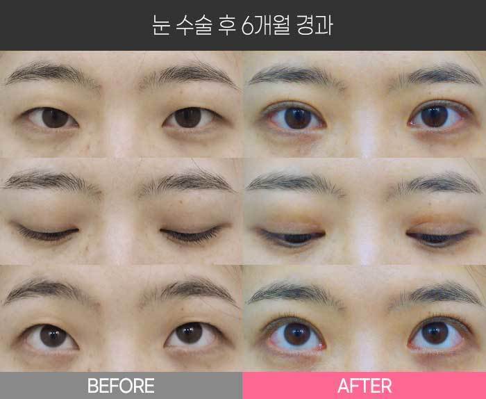 눈 수술 후 6개월 경과