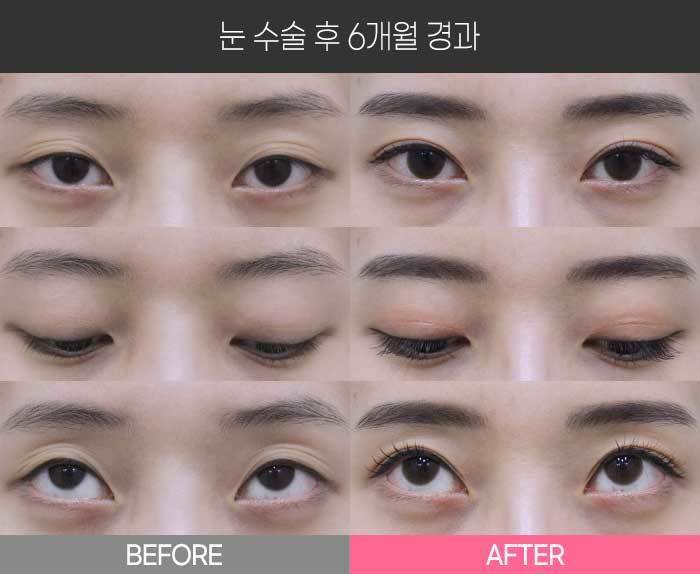 눈 수술 후 6개월 경과
