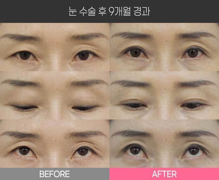 눈 수술 후 9개월 경과