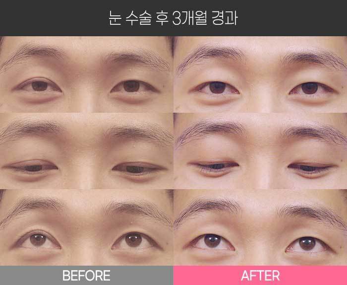 눈 수술 후 3개월 경과