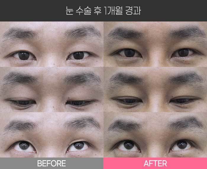 눈 수술 후 1개월 경과