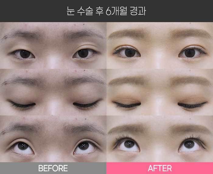 눈 수술 후 6개월 경과