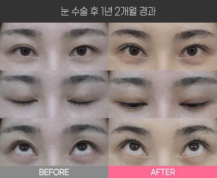 눈 수술 후 1년 2개월 경과