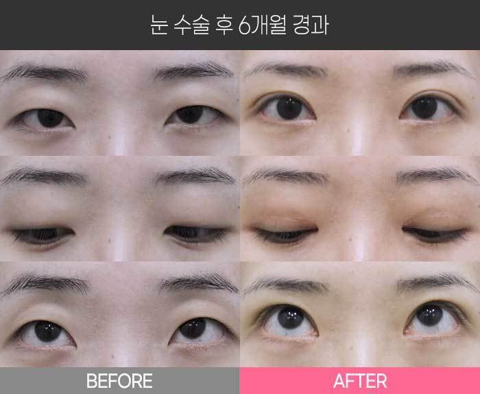 눈 수술 후 6개월 경과