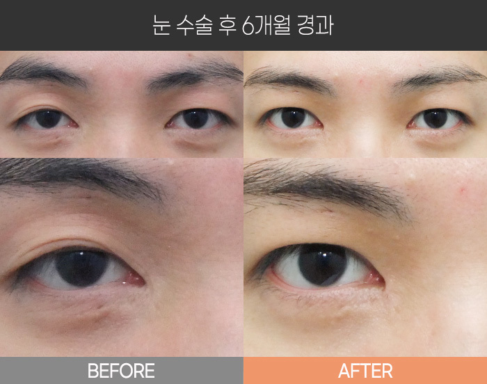 눈 수술 후 6개월 경과