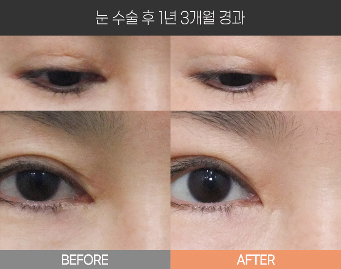 눈 수술 후 1년 3개월 경과