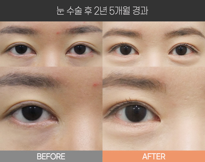 눈 수술 후 2년 5개월 경과