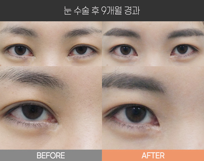 눈 수술 후 9개월 경과