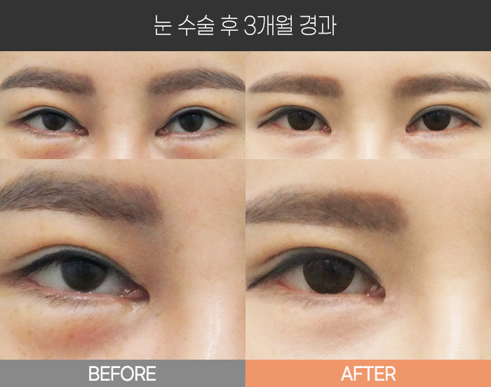 눈 수술 후 3개월 경과