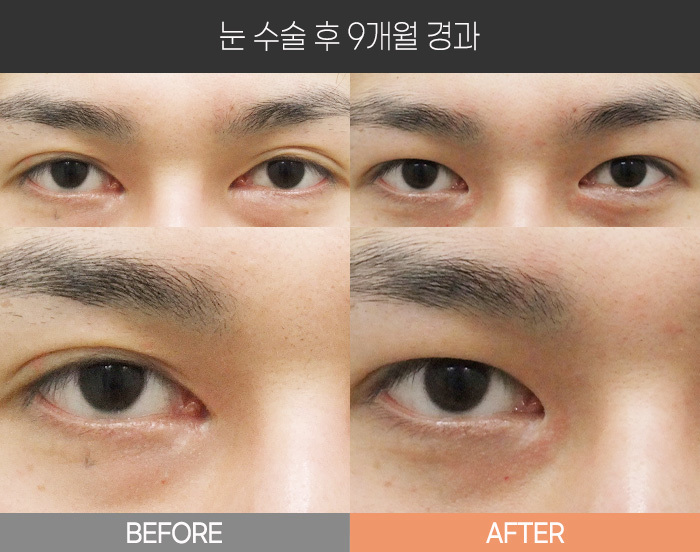 눈 수술 후 9개월 경과
