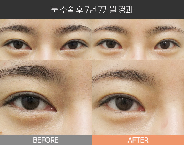 눈 수술 후 7년 7개월 경과