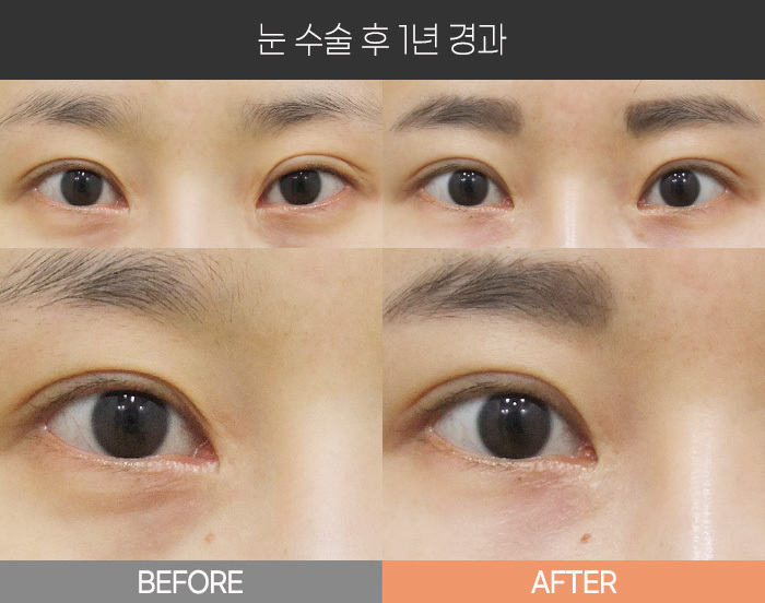 눈 수술 후 1년 경과