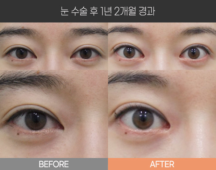 눈 수술 후 1년 2개월 경과