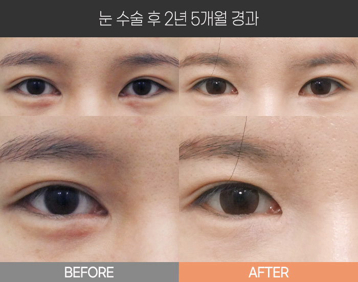 눈 수술 후 2년 5개월 경과