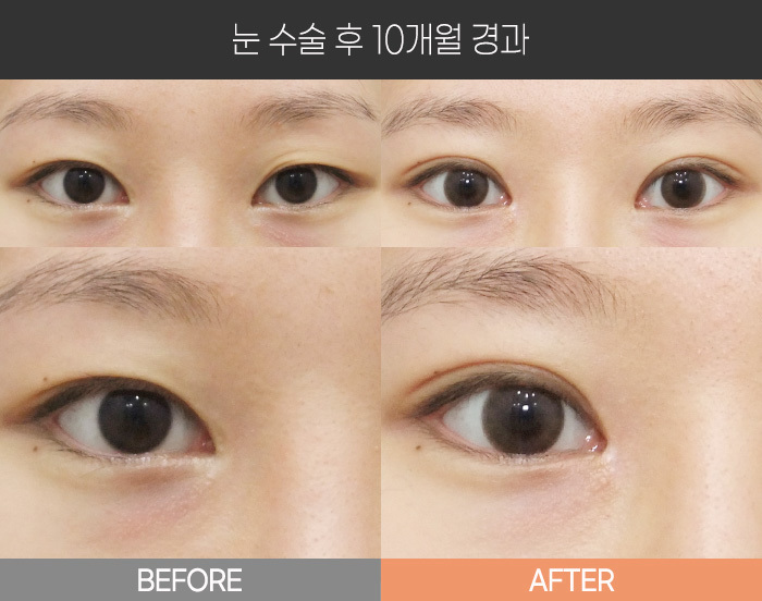 눈 수술 후 10개월 경과
