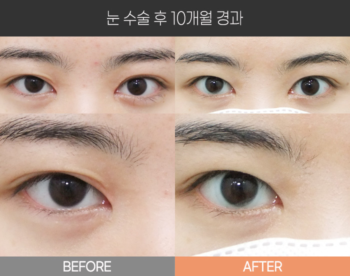 눈 수술 후 10개월 경과