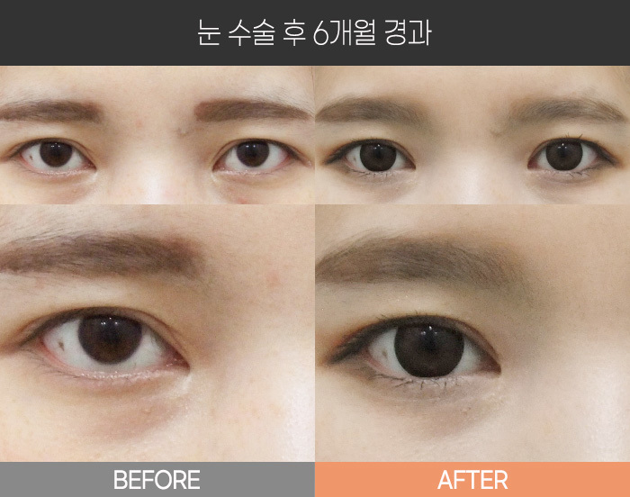 눈 수술 후 6개월 경과