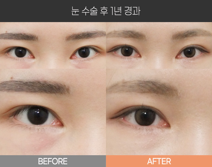 눈 수술 후 1년 경과