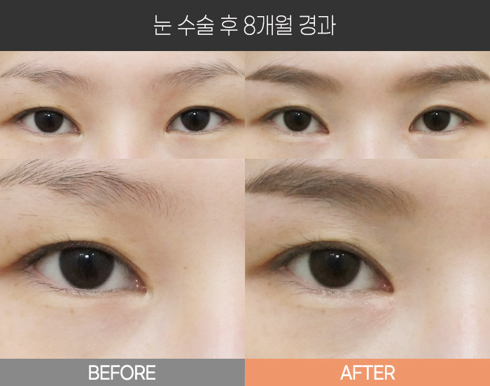 눈 수술 후 8개월 경과