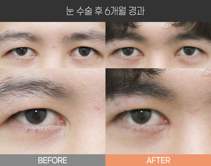 눈 수술 후 6개월 경과