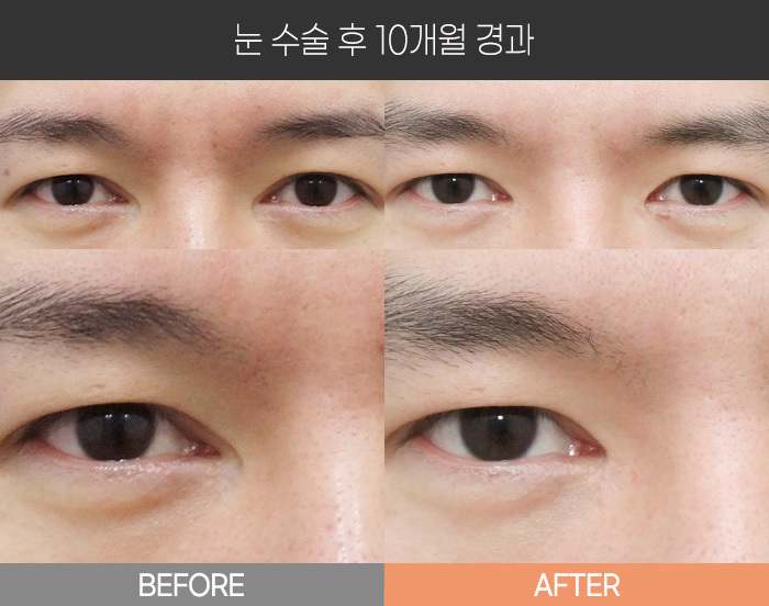 눈 수술 후 10개월 경과