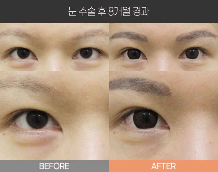 눈 수술 후 8개월 경과