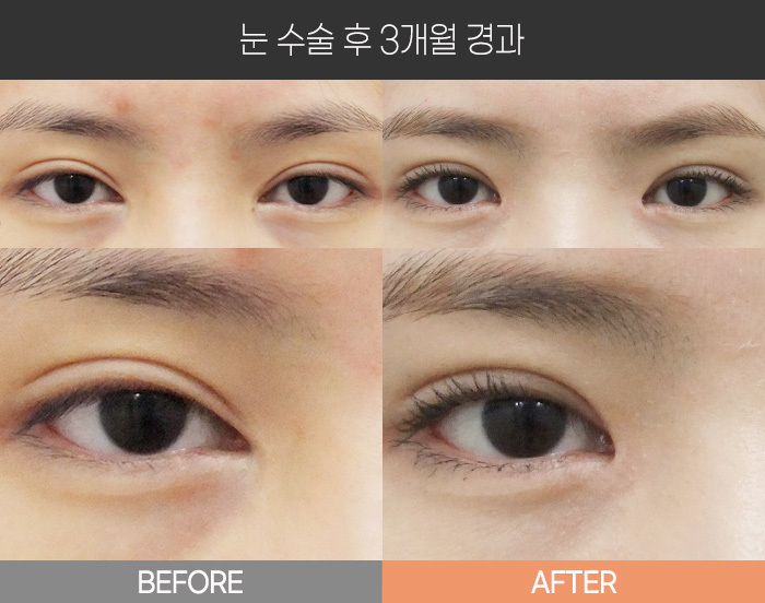 눈 수술 후 3개월 경과