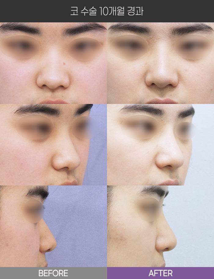 코 수술 10개월 경과