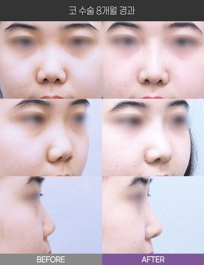 코 수술 8개월 경과
