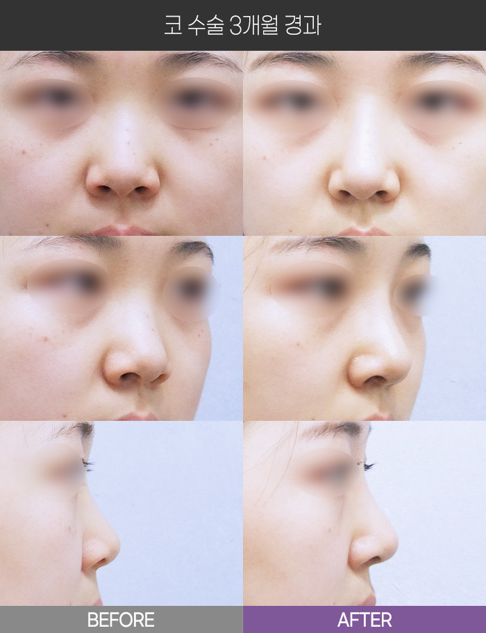 코 수술 3개월 경과