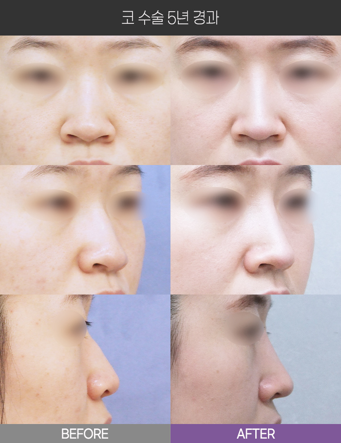 코 수술 5년 경과