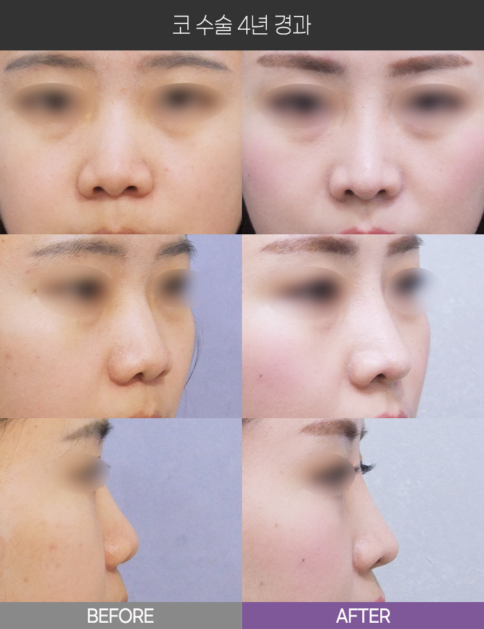 코 수술 4년 경과