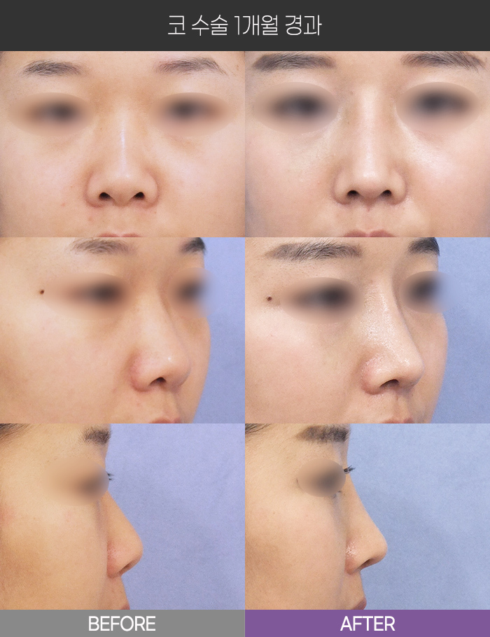 코 수술 1개월 경과