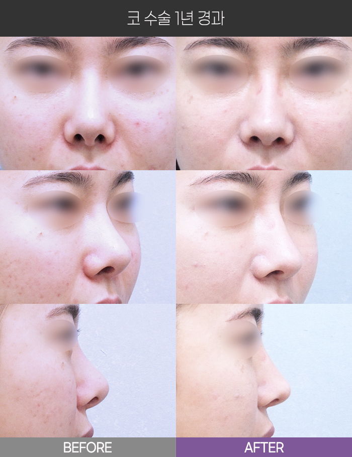 코 수술 1년 경과