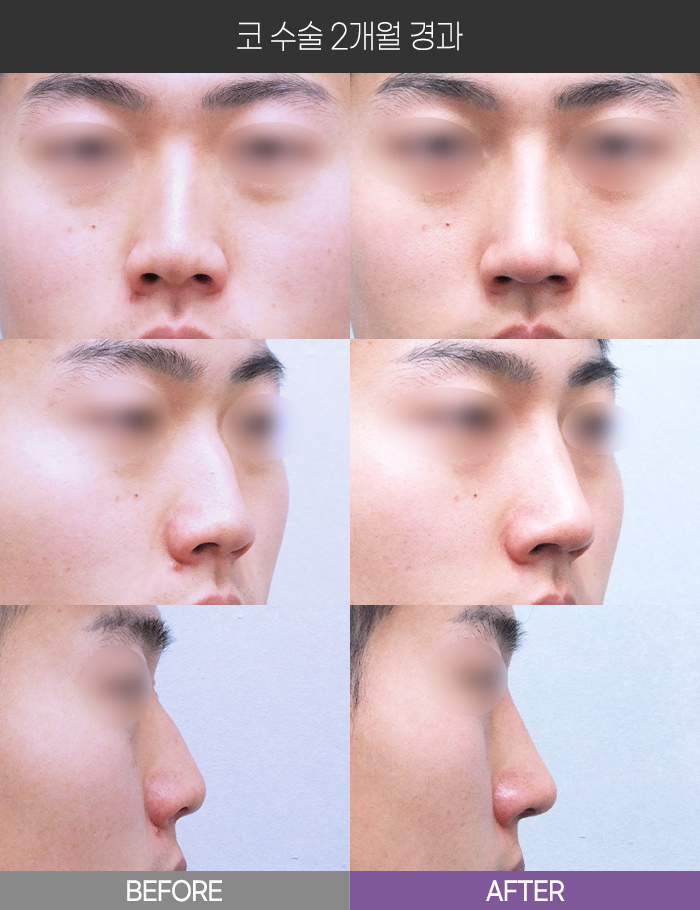 코 수술 2개월 경과