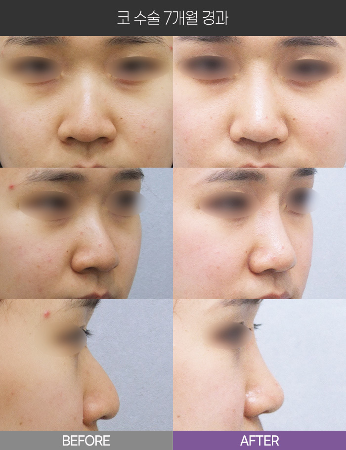 코 수술 7개월 경과