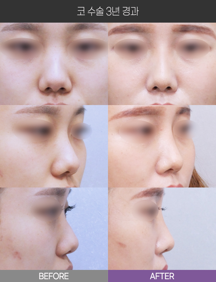 코 수술 3년 경과