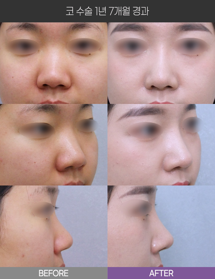 코 수술 1년 7개월 경과