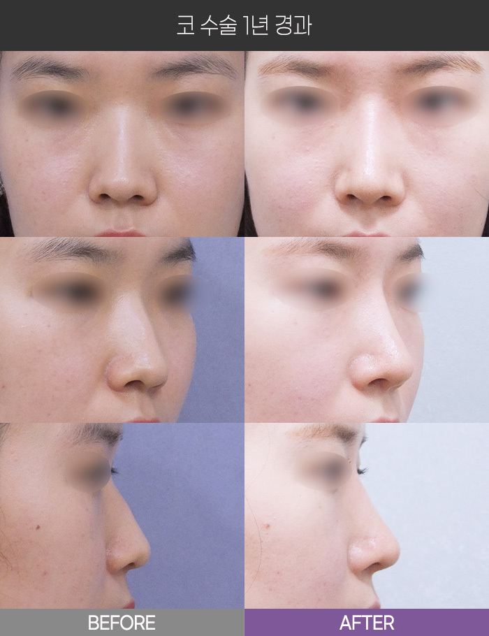 코 수술 1년 경과