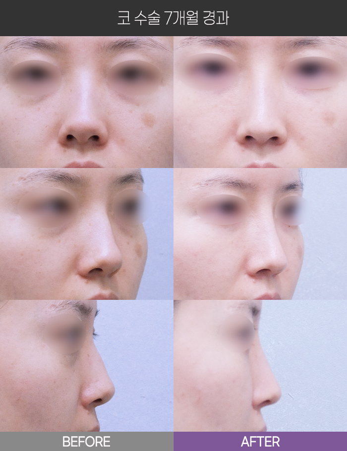 코 수술 7개월 경과