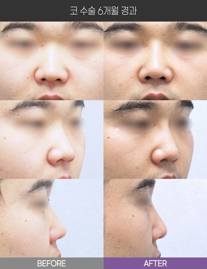 코 수술 6개월 경과