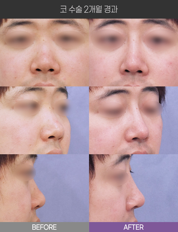 코 수술 2개월 경과