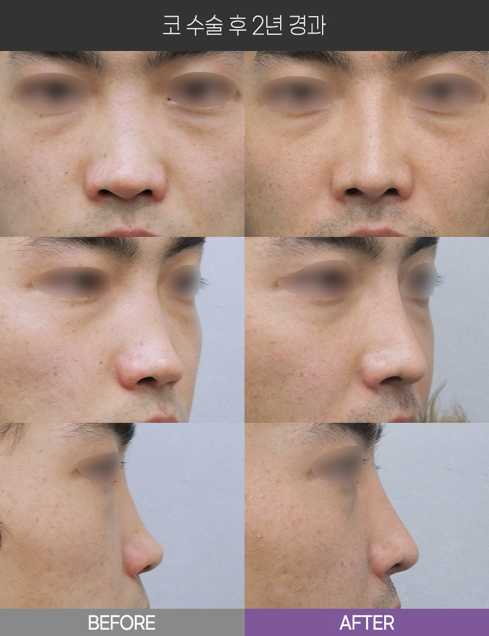 코 수술 2년 경과