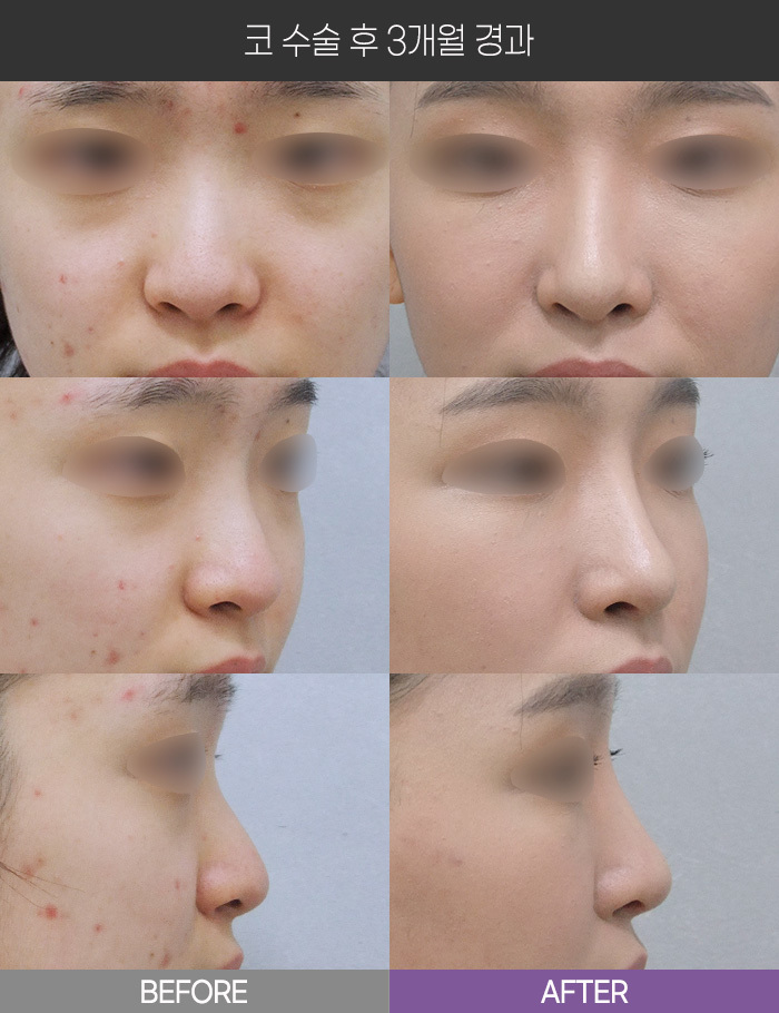 코 수술 3개월 경과