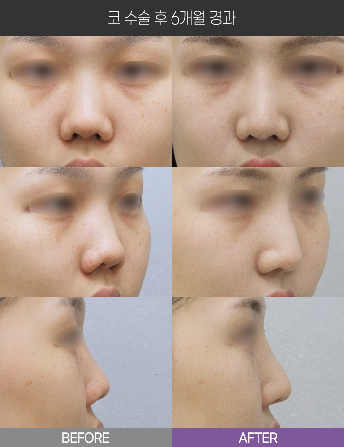 코 수술 6개월 경과
