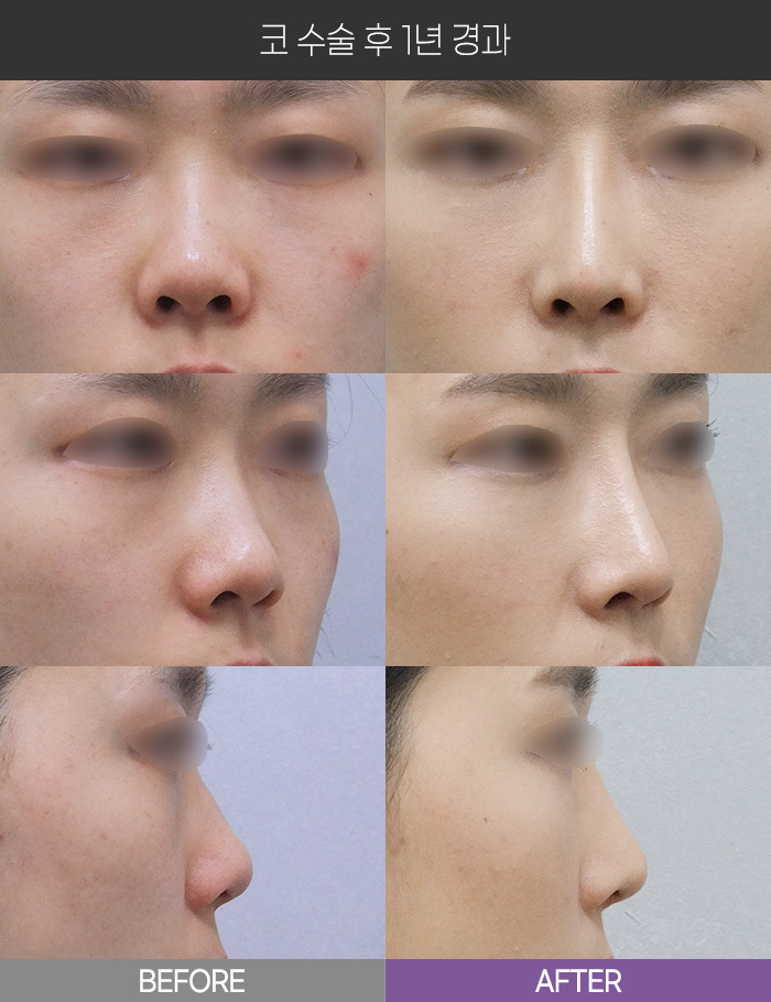 코 수술 1년 경과